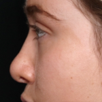 Rhinoplasty Before & After Patient #31578