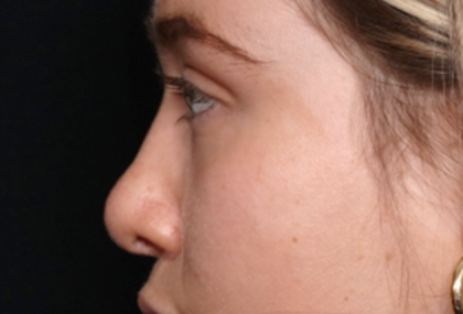 Rhinoplasty Before & After Patient #31578