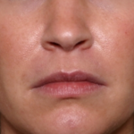 Injectable Fillers Before & After Patient #31735