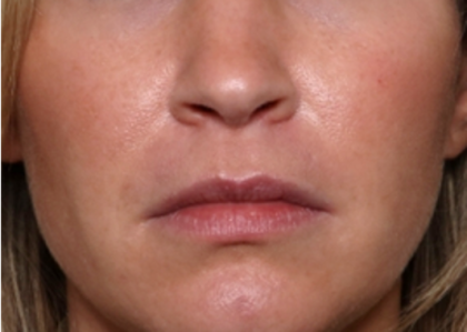 Injectable Fillers Before & After Patient #31735