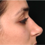 Rhinoplasty Before & After Patient #31744