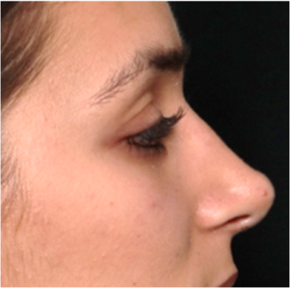 Rhinoplasty Before & After Patient #31744