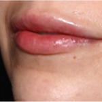 Lip Filler Before & After Patient #31757