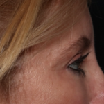 Blepharoplasty and Brow Lift Before & After Patient #31497