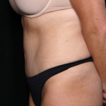 Tummy Tuck Before & After Patient #31832