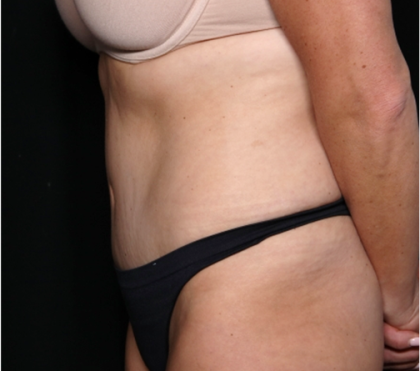 Tummy Tuck Before & After Patient #31832