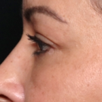 Blepharoplasty and Brow Lift Before & After Patient #31590