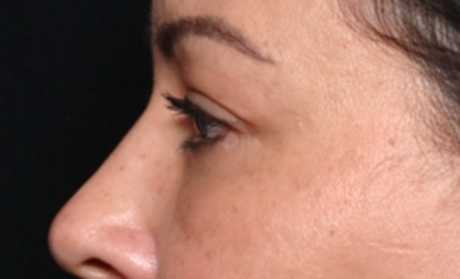 Blepharoplasty and Brow Lift Before & After Patient #31590