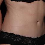 Tummy Tuck Before & After Patient #31601