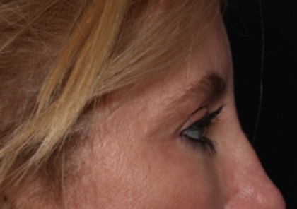 Blepharoplasty and Brow Lift Before & After Patient #31497