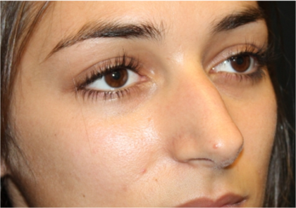 Rhinoplasty Before & After Patient #31744