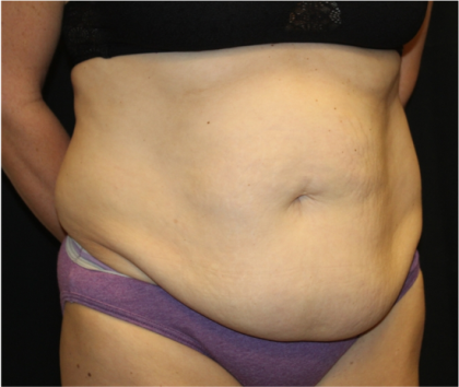 Tummy Tuck Before & After Patient #31832