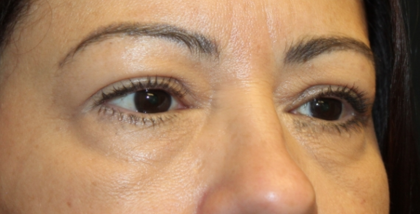 Blepharoplasty and Brow Lift Before & After Patient #31590