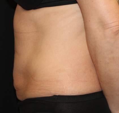 Tummy Tuck Before & After Patient #31601