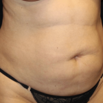 Tummy Tuck Before & After Patient #31639