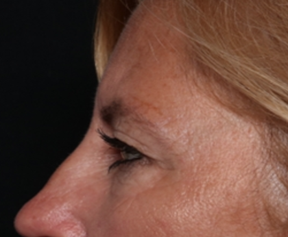 Blepharoplasty and Brow Lift Before & After Patient #31497