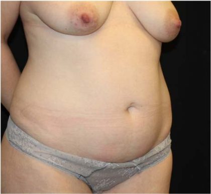 Tummy Tuck Before & After Patient #31821