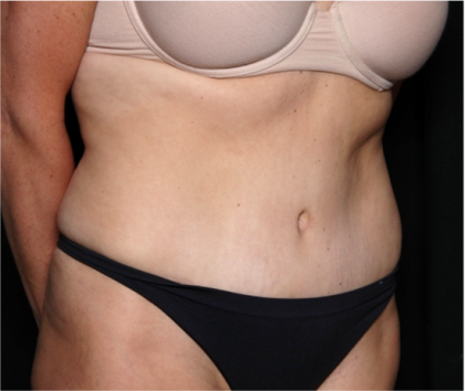 Tummy Tuck Before & After Patient #31832