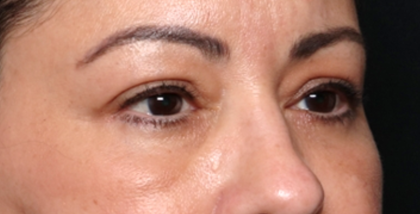 Blepharoplasty and Brow Lift Before & After Patient #31590