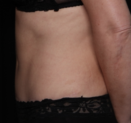 Tummy Tuck Before & After Patient #31601