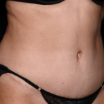 Tummy Tuck Before & After Patient #31639