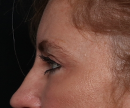 Blepharoplasty and Brow Lift Before & After Patient #31497