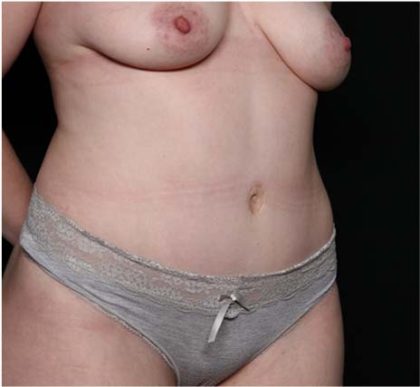 Tummy Tuck Before & After Patient #31821