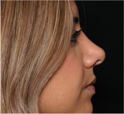 Rhinoplasty Before & After Patient #31701