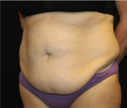 Tummy Tuck Before & After Patient #31832