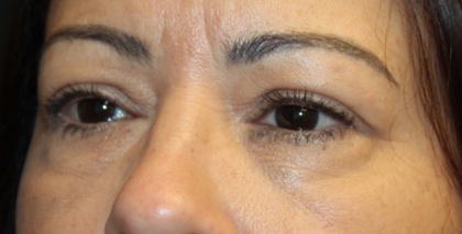 Blepharoplasty and Brow Lift Before & After Patient #31590