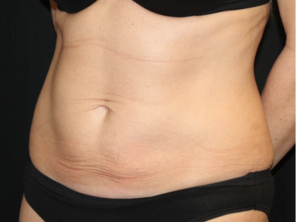 Tummy Tuck Before & After Patient #31601