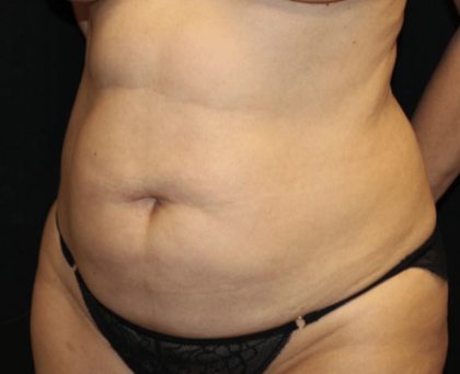 Tummy Tuck Before & After Patient #31639