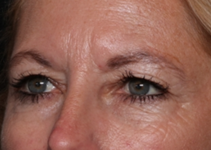 Blepharoplasty and Brow Lift Before & After Patient #31497