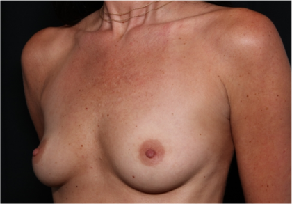 Breast Augmentation Before & After Patient #31714