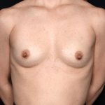 Breast Augmentation Before & After Patient #31540