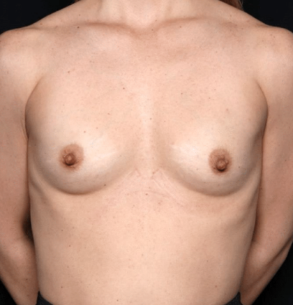 Breast Augmentation Before & After Patient #31540
