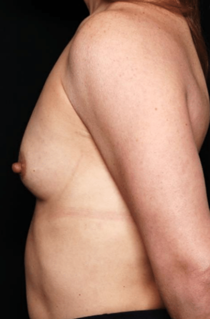 Breast Augmentation Before & After Patient #31540