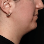 Kybella Before & After Patient #31551