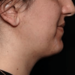 Kybella Before & After Patient #31551