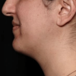 Kybella Before & After Patient #31551