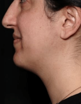 Kybella Before & After Patient #31551