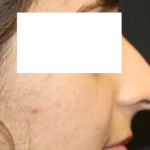 Rhinoplasty Before & After Patient #31810