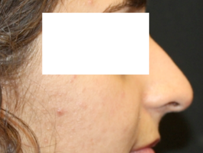 Rhinoplasty Before & After Patient #31810