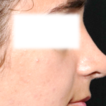 Rhinoplasty Before & After Patient #31810