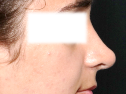 Rhinoplasty Before & After Patient #31810