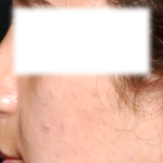 Rhinoplasty Before & After Patient #31810