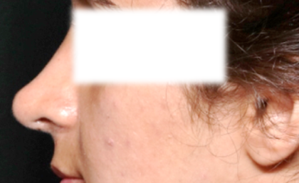 Rhinoplasty Before & After Patient #31810