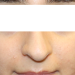 Rhinoplasty Before & After Patient #31810