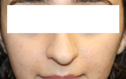 Rhinoplasty Before & After Patient #31810