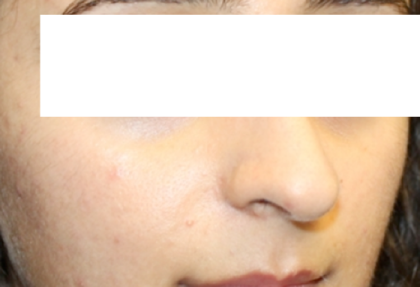 Rhinoplasty Before & After Patient #31810